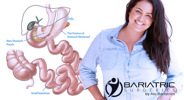 Mexico Gastric Sleeve